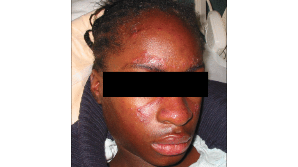 Mulher jovem com lesões lúpus no rosto