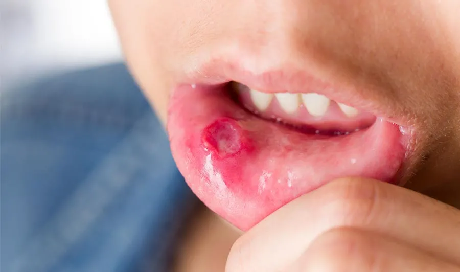 Doença de Behçet: sintomas, diagnóstico e tratamento com reumatologista